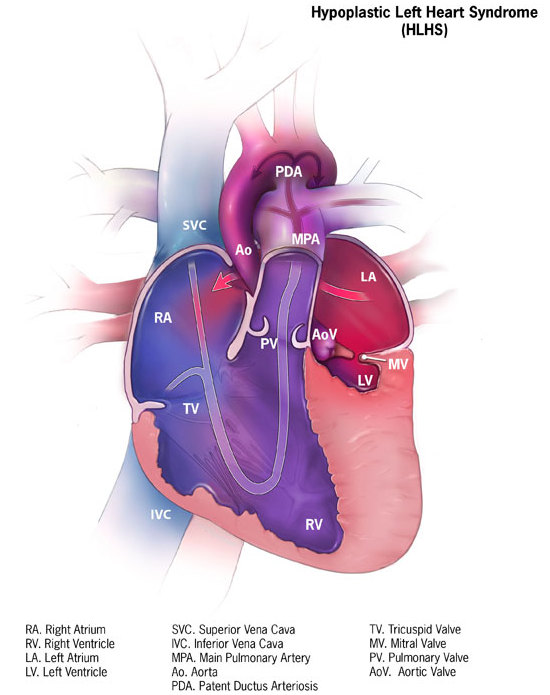 Image of the heart of a patient with Hypoplastic Left Heart Syndrome, licence: CC0