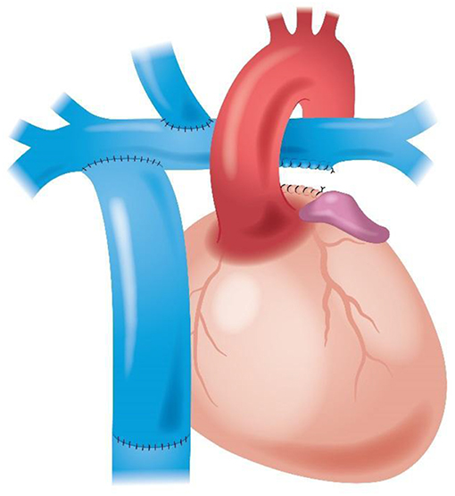 Picture of post Fontan (our physiological Fontan), licence: CC-BY